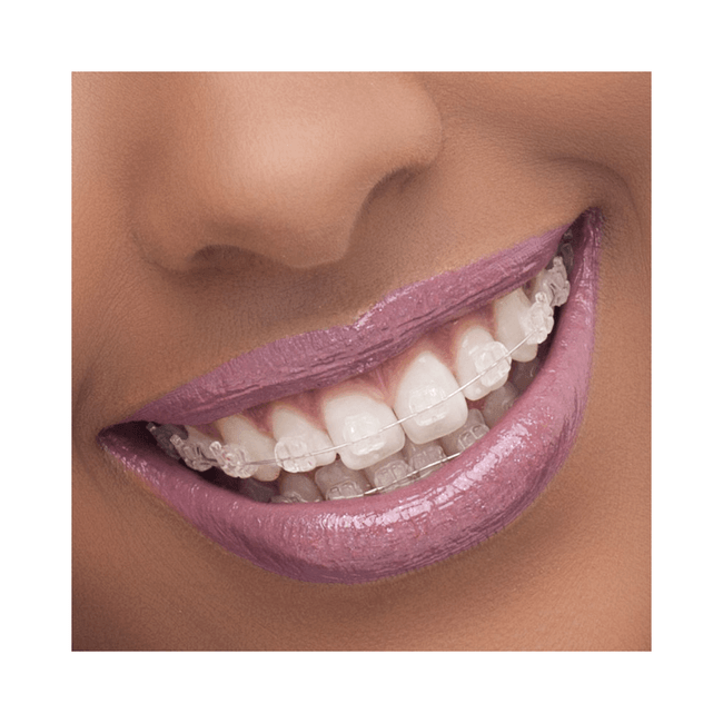 Braquete Ceramico Iceram Safira Roth 022  Orthometric