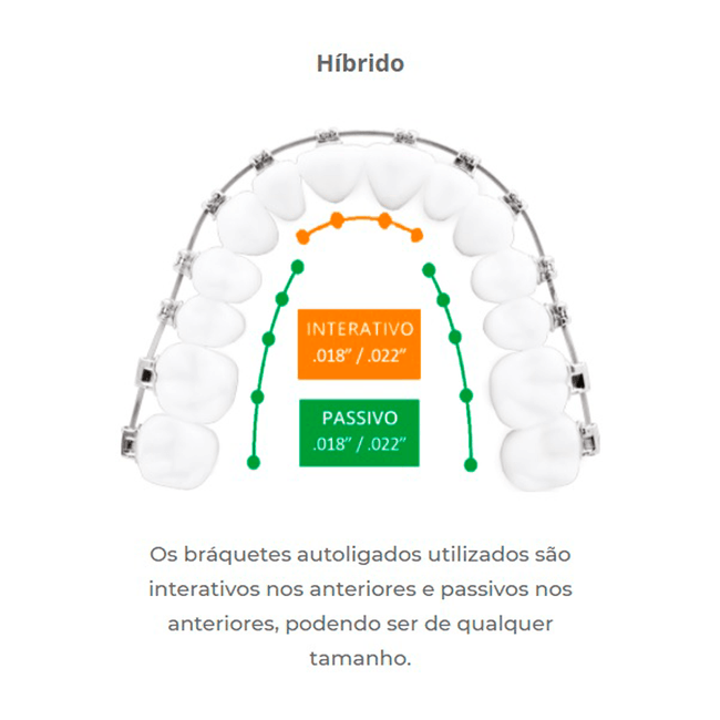 Kit Braquete de Aco Autoligado EasyClip Bidimensional PDM 022  Aditek