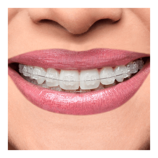 Braquete-Ceramico-Iceram-P-MBT-022---Orthometric